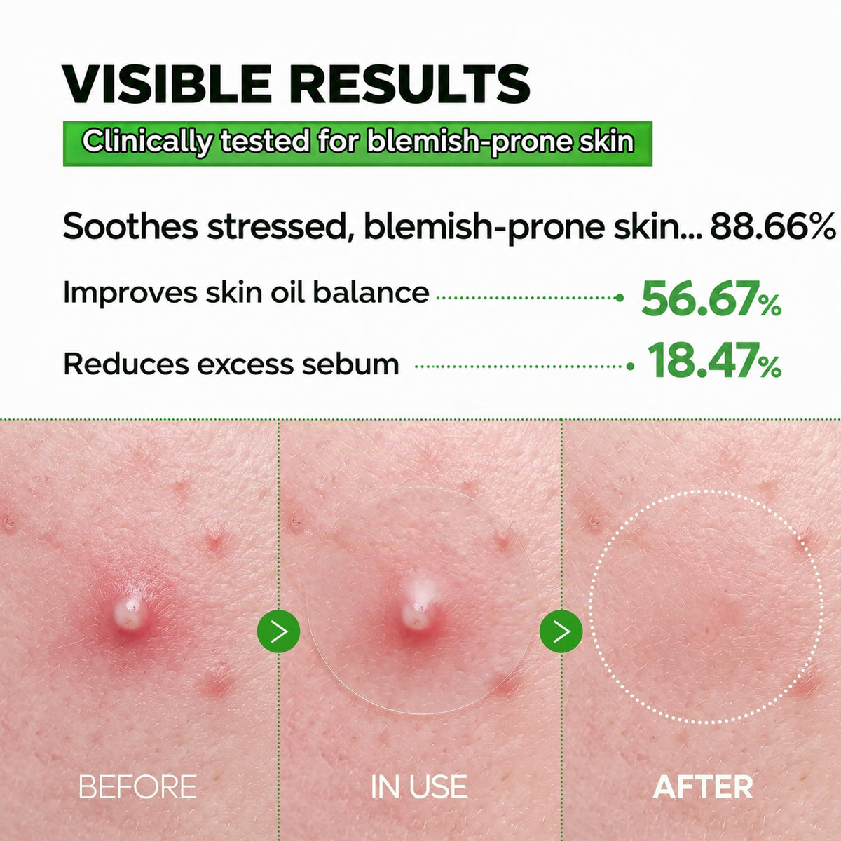 ✨🌿 Invisible Ultra-Thin Pimple Patches for Face – 0.013mm Clear Acne & Zit Stickers Under Makeup with Sulfur, Salicylic Acid, AHA & PHA, Korean Skincare, 72 Count